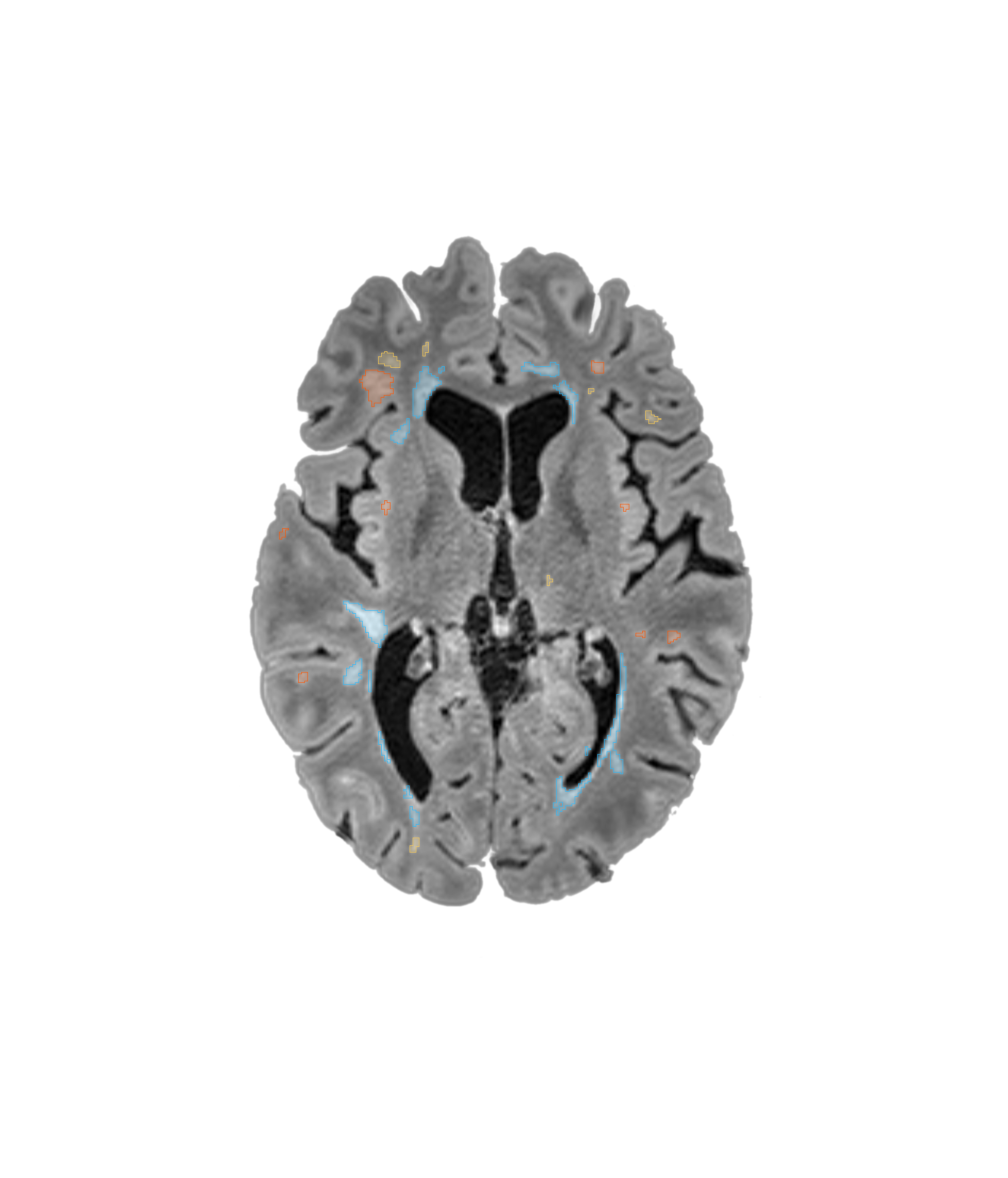 Brain lesions segmentation example slice created by Hetalox